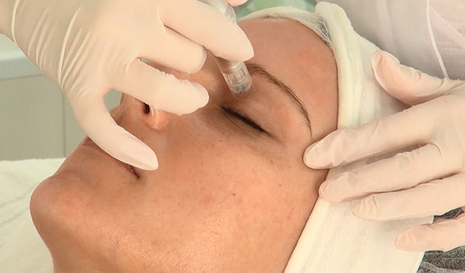 Micro Needling